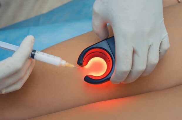 Treatment of varicose veins with sclerotherapy