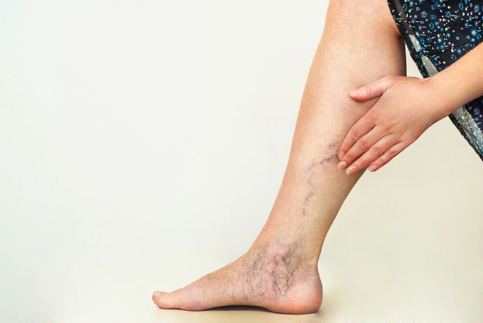 vascular pathology in varicose veins