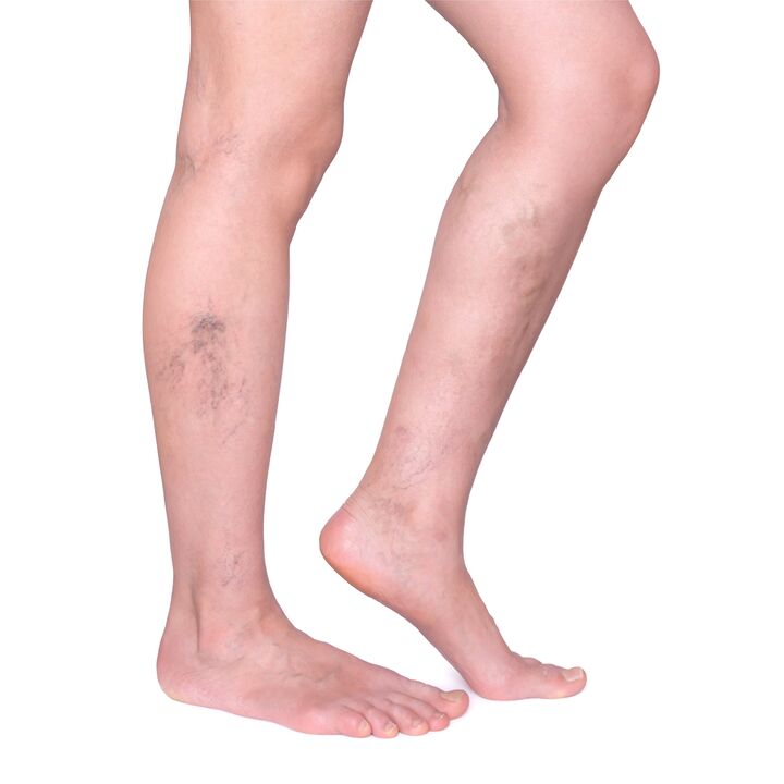 indications for Neoveris - swollen and tortuous veins on the legs